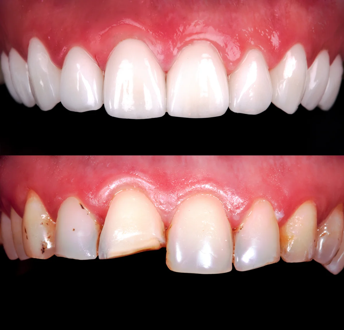Cosmetic dentistry before and after result — after